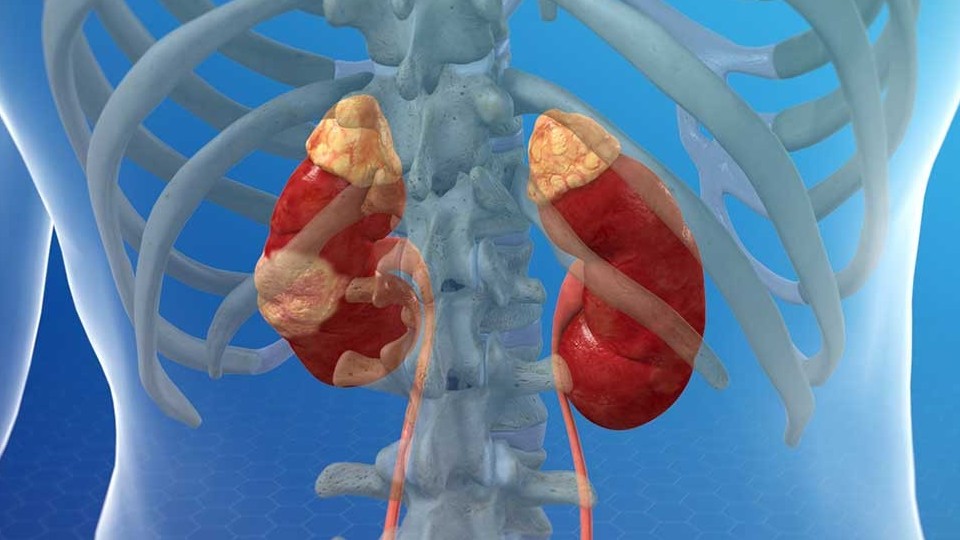 Ung thư thận có dấu hiệu sớm không?