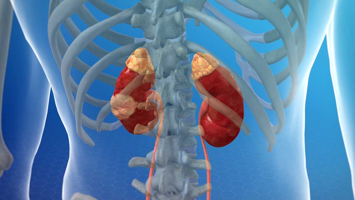 Chuyên gia khuyên chế độ ăn uống tốt cho người bệnh ung thư thận