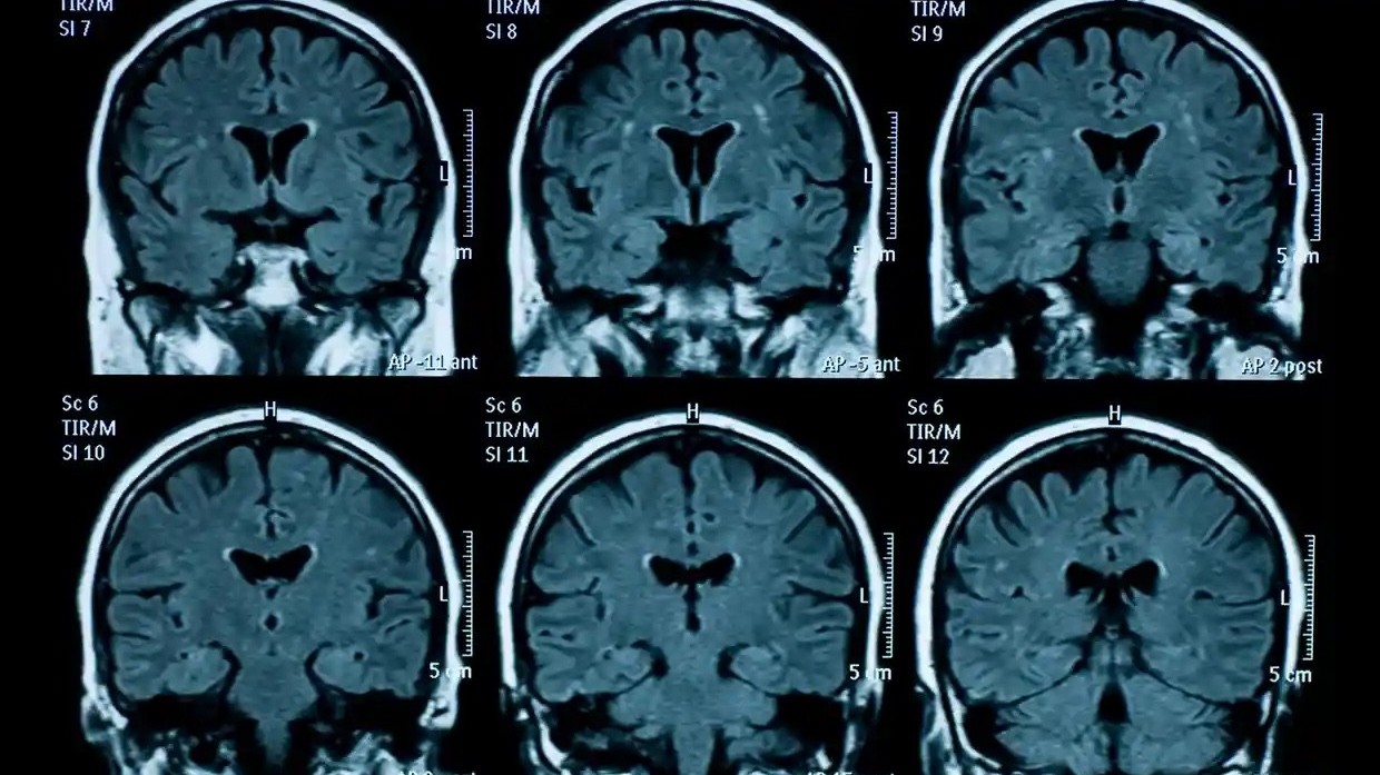 Dấu hiệu lão hóa sớm ở não bộ thanh thiếu niên sau đại dịch Covid-19