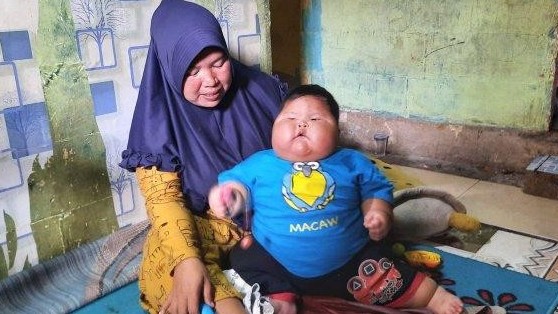 Indonesi: Bé trai 16 tháng nặng 27 kg được hỗ trợ giảm cân