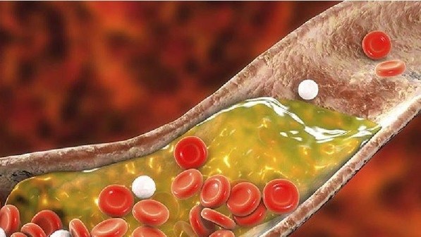 Bạn cần biết: Bí quyết nấu ăn giúp giảm mỡ máu, hạn chế nguy cơ đột quỵ