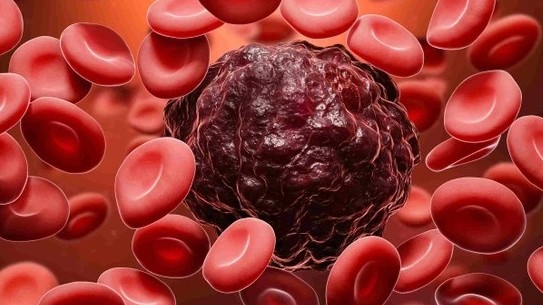 Những triệu chứng ung thư máu dễ bị người bệnh bỏ qua