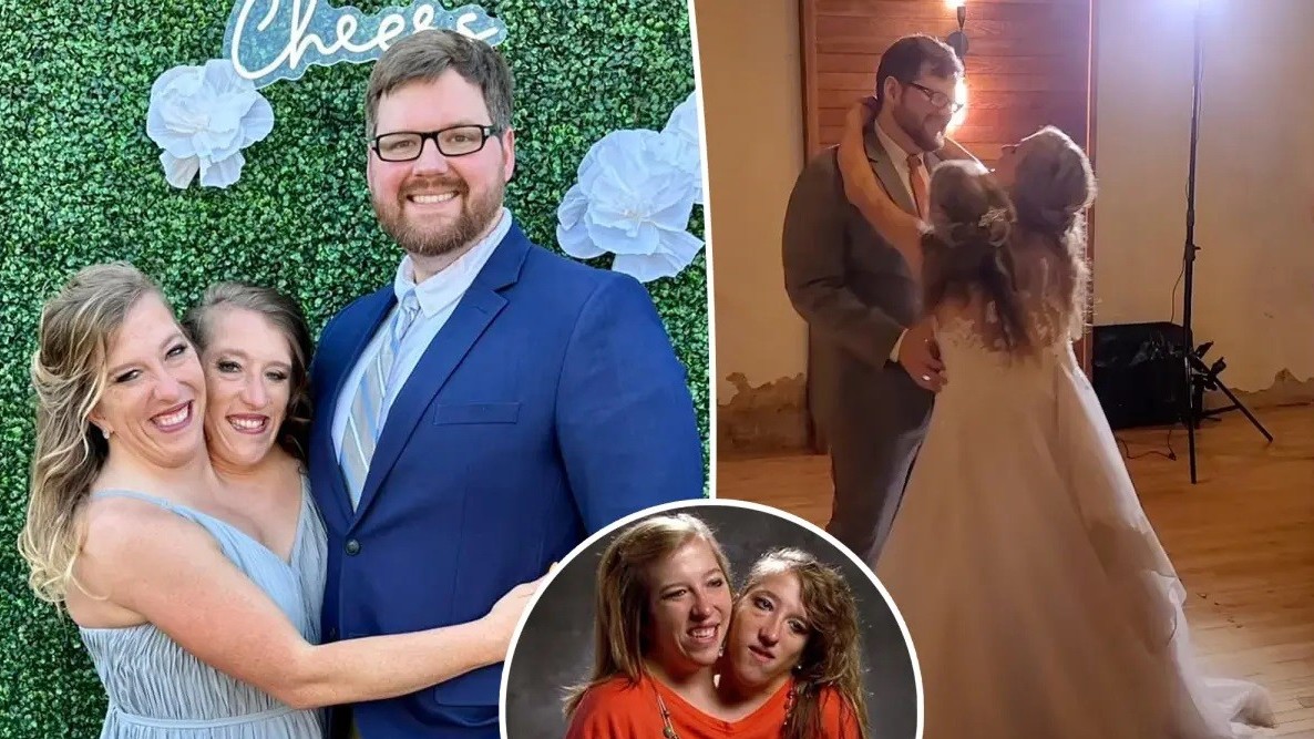 Mỹ: Người phụ nữ trong cặp song sinh dính liền thân đã kết hôn