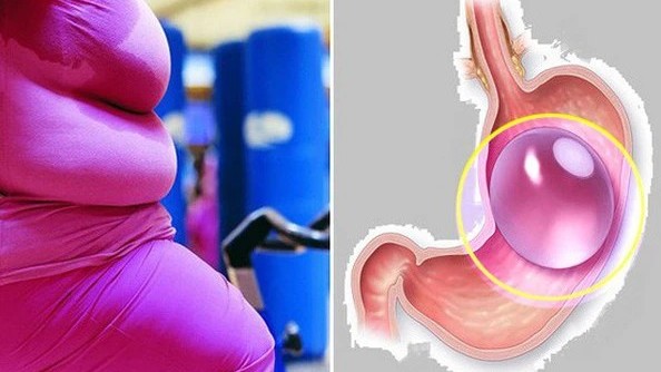 Cô gái tử vong vì đặt bóng hơi vào dạ dày để giảm cân trước ngày cưới