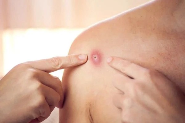 Bệnh đậu mùa khi do virus Mpox gây ra, người mắc bệnh thường có các triệu chứng như mọc mụn nhọt hoặc mụn nước như phát ban, sốt, đau đầu. (Nguồn: Vinmec)