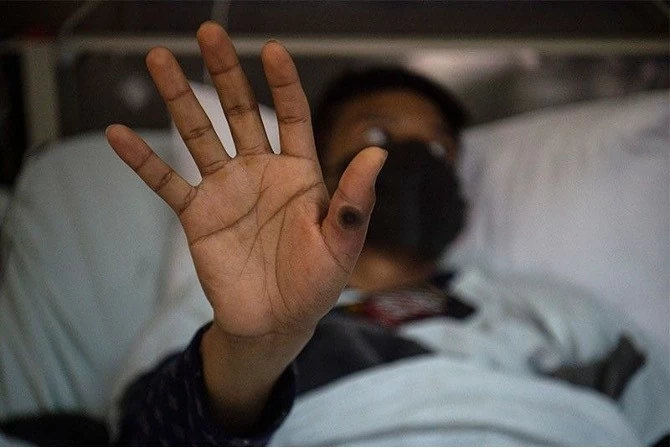 Một bệnh nhân cho thấy bàn tay bị loét do nhiễm virus đậu mùa khỉ, tại khu vực cách ly dành cho bệnh nhân đậu mùa khỉ tại bệnh viện Arzobispo Loayza, ở Lima vào ngày 16 tháng 8 năm 2022. Gần 28.000 trường hợp đã được xác nhận trên toàn thế giới trong ba tháng qua và những ca tử vong đầu tiên đang bắt đầu được ghi nhận. (Nguồn: AFP) Một bệnh nhân cho thấy bàn tay bị loét do nhiễm virus đậu mùa khỉ, tại khu vực cách ly dành cho bệnh nhân đậu mùa khỉ tại bệnh viện Arzobispo Loayza, ở Lima vào ngày 16 tháng 8 năm 2022. Gần 28.000 trường hợp đã được xác nhận trên toàn thế giới trong ba tháng qua và những ca tử vong đầu tiên đang bắt đầu được ghi nhận. (Nguồn: AFP)