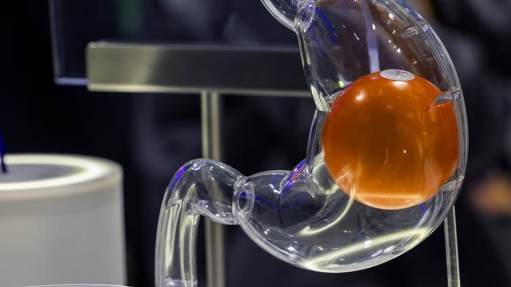 Kiểm soát cân nặng, chống béo phì hiệu quả bằng phương pháp đặt bóng hơi trong dạ dày