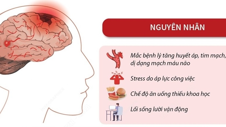 Nguyên nhân và cách phòng ngừa đột quỵ ở người trẻ tuổi