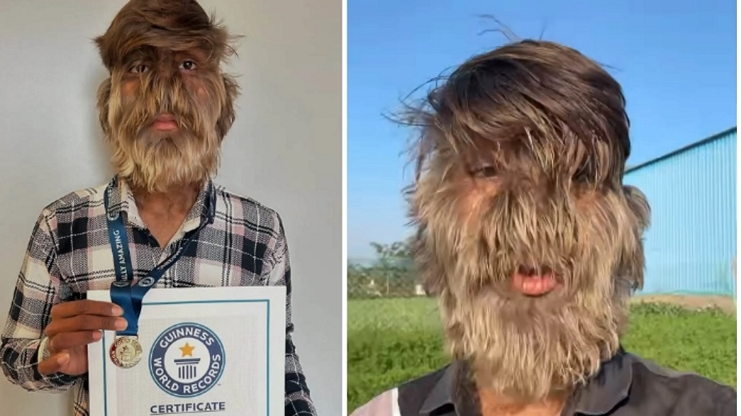 Ấn Độ: Thanh niên 18 tuổi mắc bệnh 'hội chứng người sói' lập kỷ lục Guinness