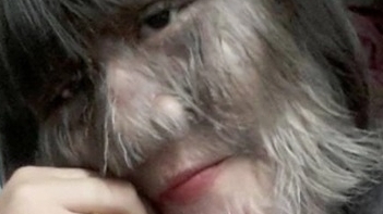 Câu chuyện truyền cảm hứng về lối sống tốt đẹp của cô gái mắc 'hội chứng người sói'