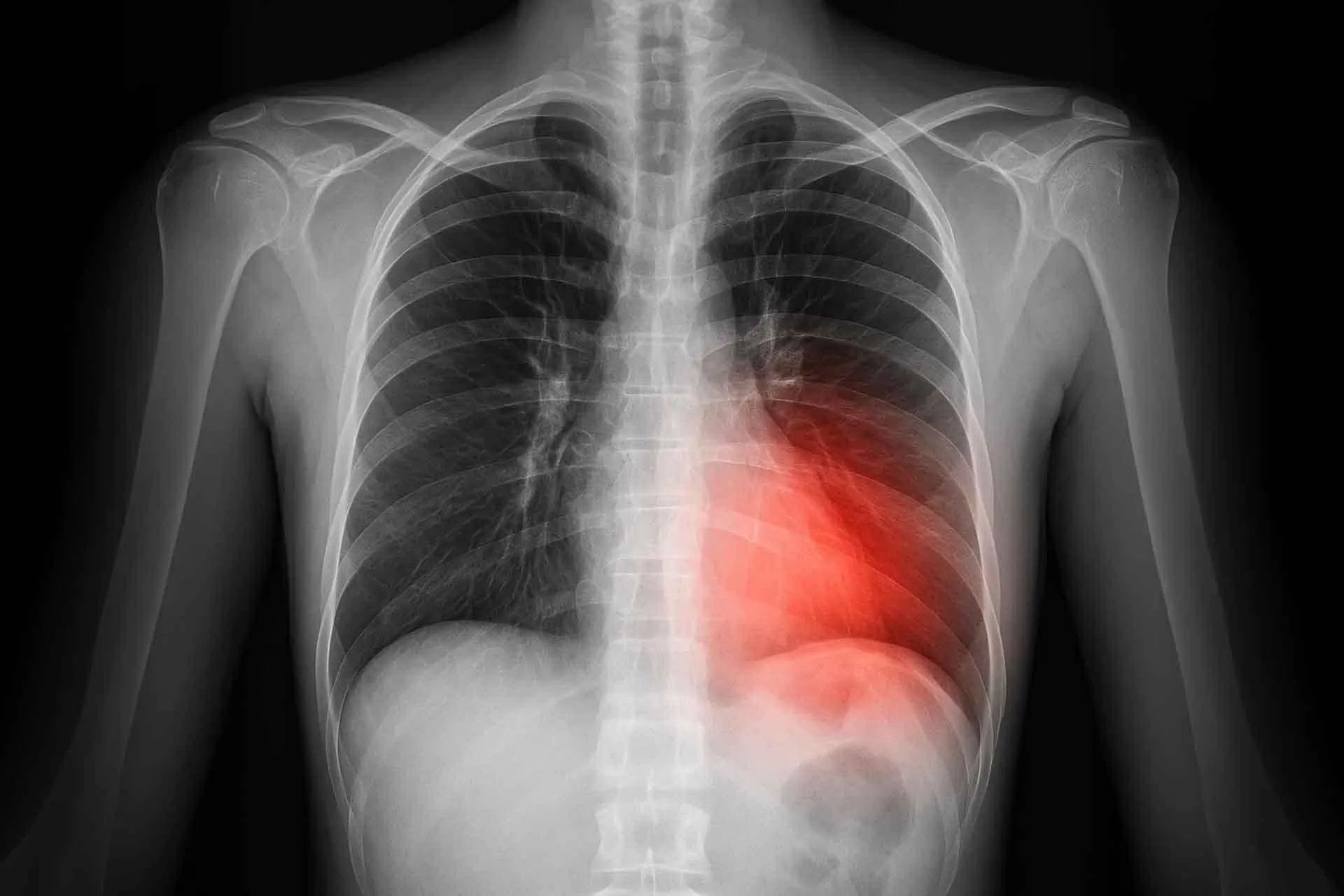 Phát hiện lỗi gene liên quan xẹp phổi và ung thư thận