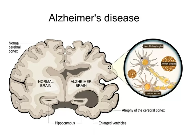 Một số người có mảng bám amyloid và đám rối tau liên quan đến bệnh Alzheimer nhưng không bao giờ mắc chứng mất trí. Minh họa: Shutterstock Một số người có mảng bám amyloid và đám rối tau liên quan đến bệnh Alzheimer nhưng không bao giờ mắc chứng mất trí. Minh họa: Shutterstock