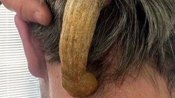 Chiếc sừng dài hơn 12cm mọc sau đầu người đàn ông 30 tuổi