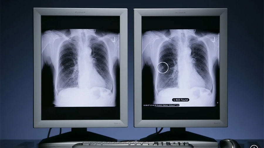 Hy vọng mới cho bệnh nhân ung thư phổi: Thuốc mới an toàn, hiệu quả với mức chi phí thử nghiệm lâm sàng hợp lý