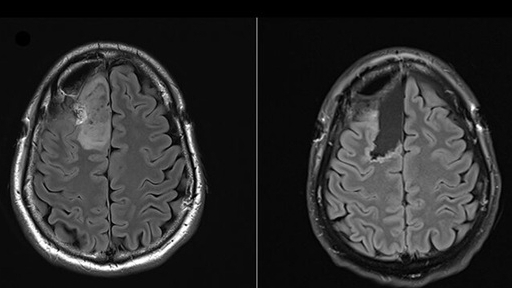 Thử nghiệm lâm sàng lần đầu tiên trên thế giới về phương pháp điều trị u não