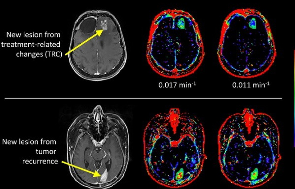 Tìm ra phương pháp mới chữa u não mà không cần phẫu thuật