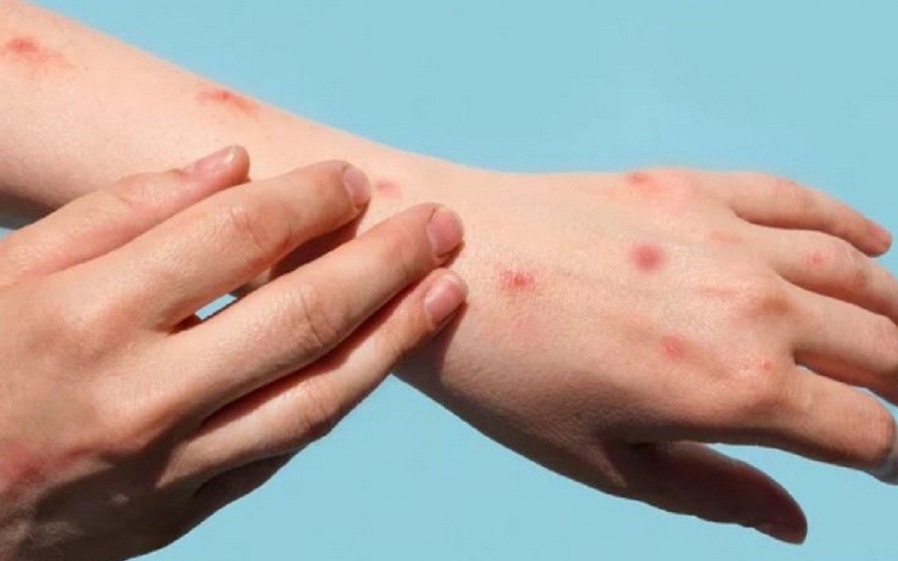 Để chủ động phòng chống dịch bệnh đậu mùa khỉ ở nước ta, Bộ Y tế khuyến cáo người dân chủ động thực hiện các biện pháp phòng bệnh Để chủ động phòng chống dịch bệnh đậu mùa khỉ ở nước ta, Bộ Y tế khuyến cáo người dân chủ động thực hiện các biện pháp phòng bệnh