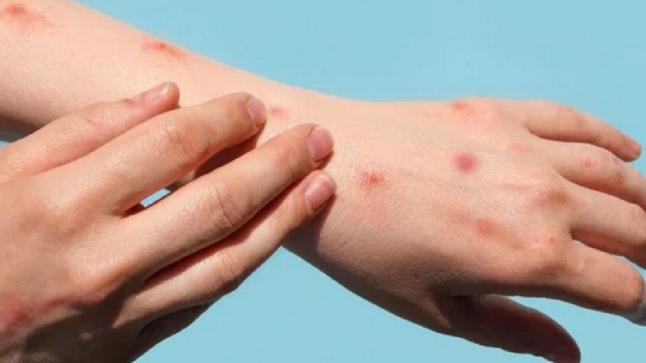 6 biện pháp phòng, chống dịch bệnh đậu mùa khỉ