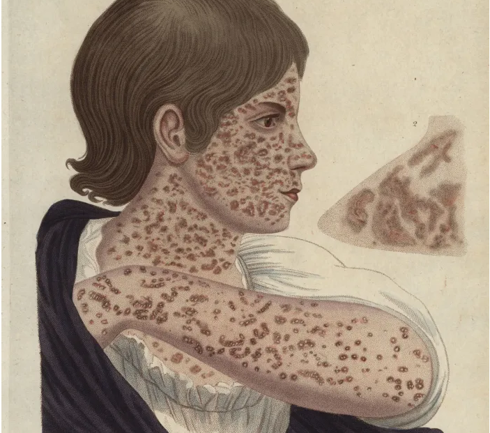 Những đại dịch góp phần thay đổi lịch sử (kỳ 2) nhung dai dich gop phan thay doi lich su ky 2