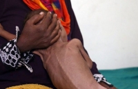 UNICEF: Hơn 30% trẻ em thế giới có vấn đề về dinh dưỡng