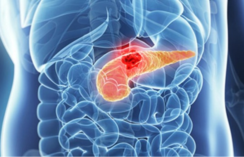 Chẩn đoán sớm - yếu tố quan trọng trong điều trị ung thư tụy