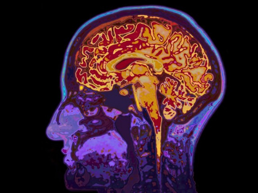 Bước tiến lớn trong việc điều trị bệnh Alzheimer