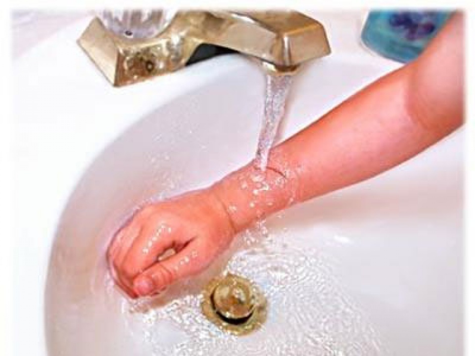 Các nguyên tắc không thể bỏ qua khi sơ cứu bỏng