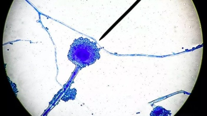 Chưa hết bàng hoàng vì Covid-19, Ấn Độ lại bị bệnh nấm đen chết người 'tấn công'