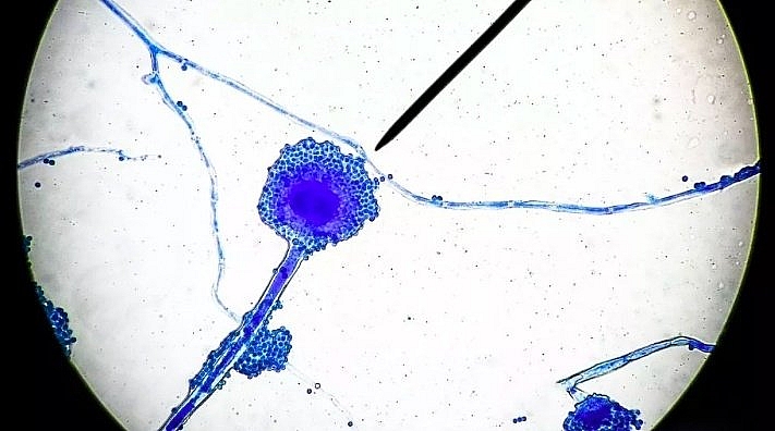 Chưa hết bàng hoàng vì Covid-19, bệnh nấm đen chết người lại 'đe dọa' Ấn Độ Chưa hết bàng hoàng vì Covid-19, Ấn Độ lại bị bệnh nấm đen chết người 'tấn công'
