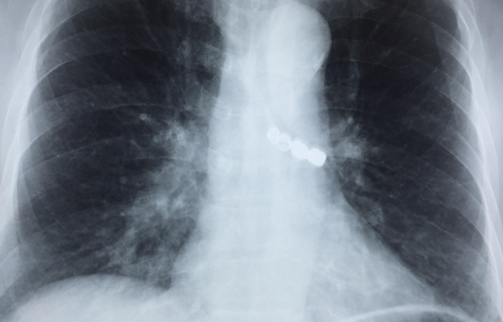 Cứu sống cụ ông rơi cả cầu răng giả vào phế quản