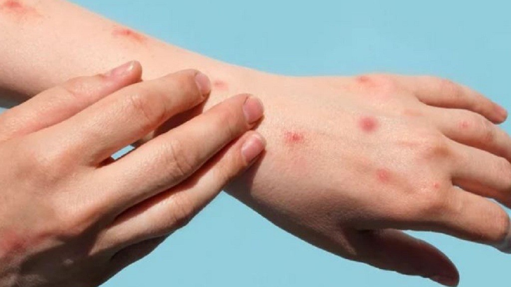 Bỉ có ca tử vong đầu tiên liên quan đến bệnh đậu mùa khỉ