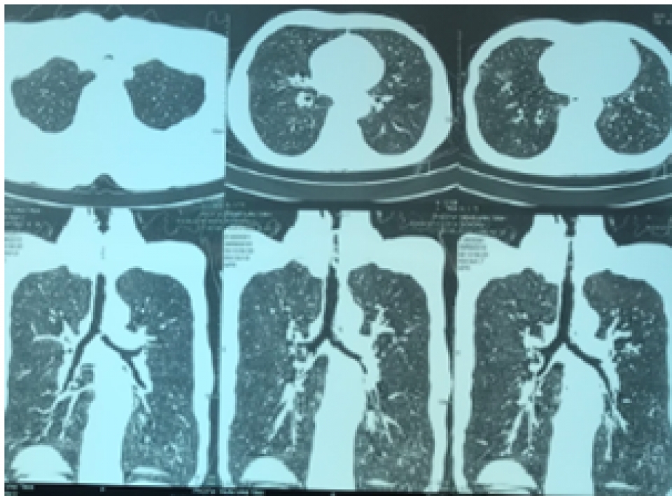 Cứu sống bệnh nhân suy hô hấp do hẹp khí quản cuu song benh nhan suy ho hap do hep khi quan
