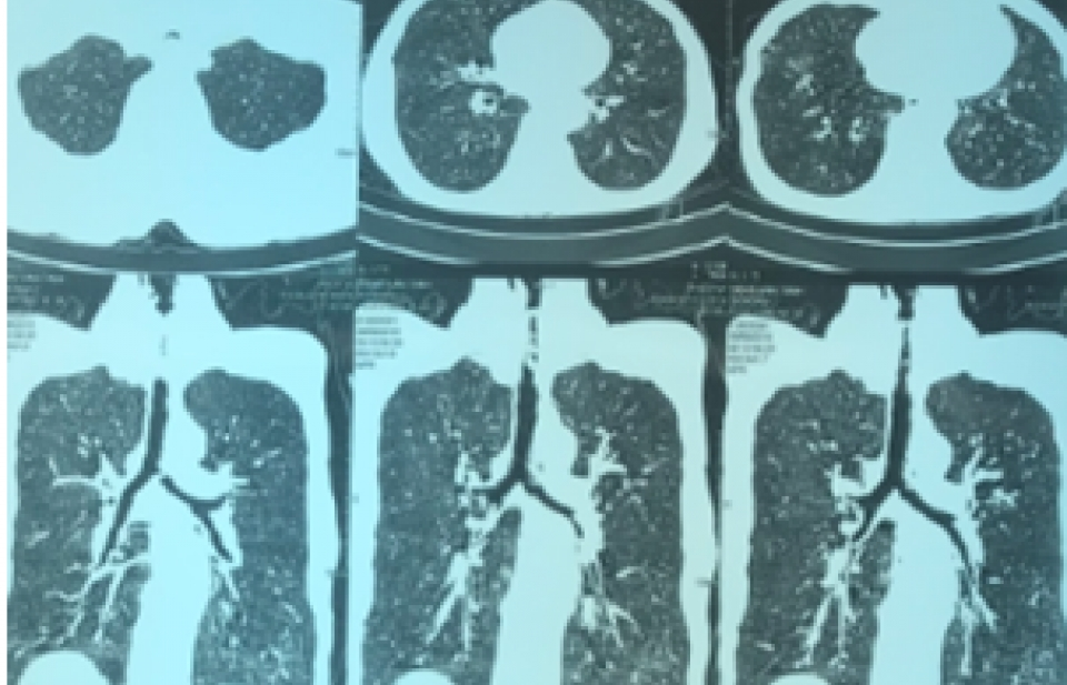 Cứu sống bệnh nhân suy hô hấp do hẹp khí quản