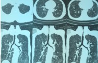 Cứu sống bệnh nhân suy hô hấp do hẹp khí quản