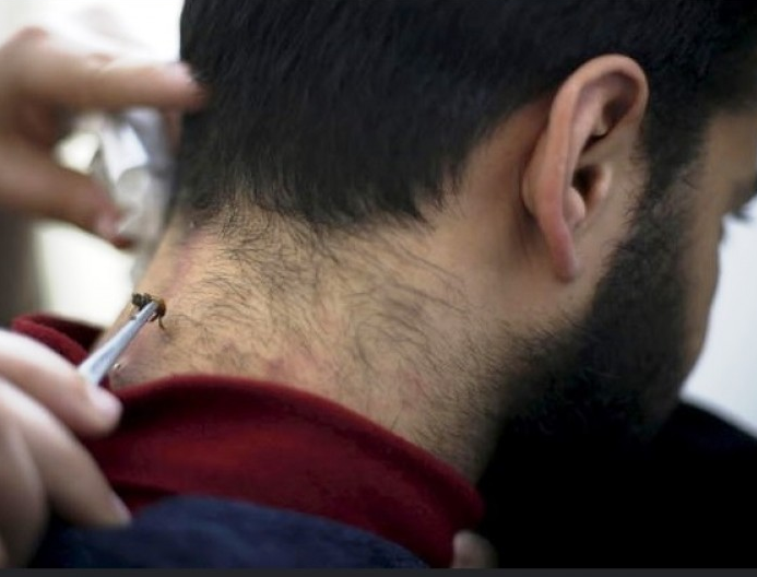 Cho ong đốt để chữa bệnh