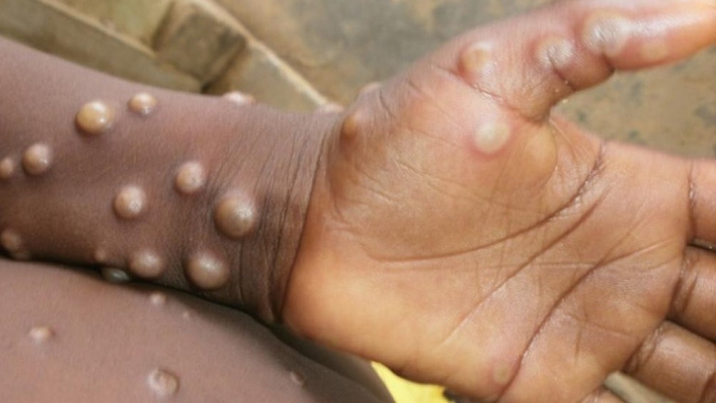 Mỹ cảnh báo về dịch bệnh đậu mùa khỉ