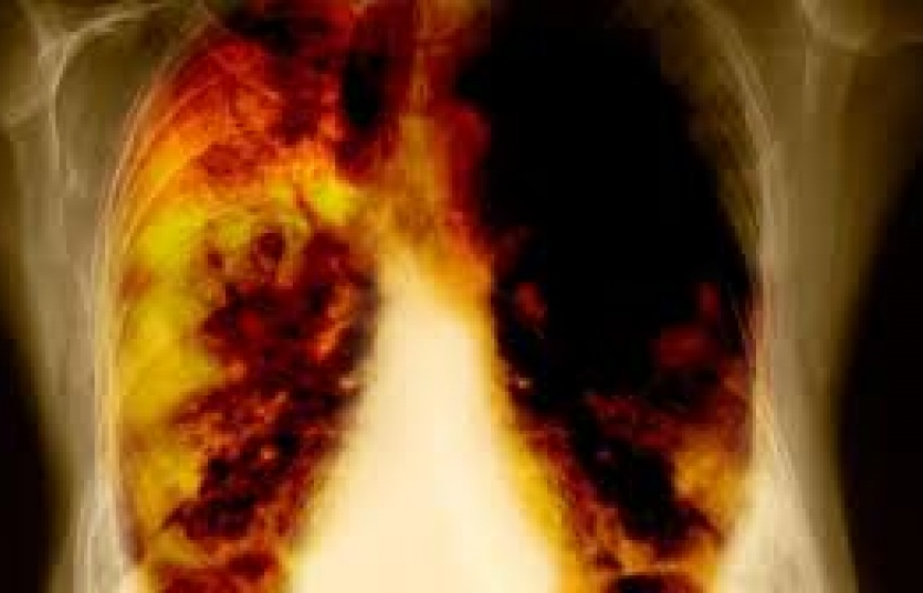 Xạ trị não bộ không trị được di căn ung thư