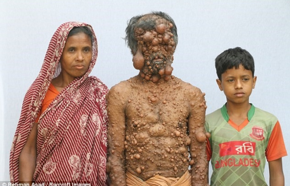 Người đàn ông 'trăm u' bị xa lánh ở Bangladesh