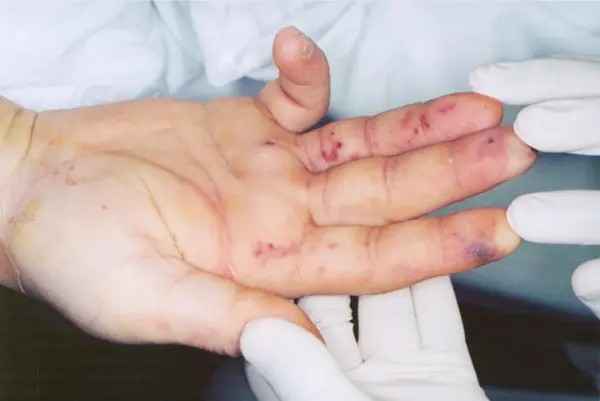 Nốt Osler trên tay bệnh nhân. Ảnh: Grepmed Nốt Osler trên tay bệnh nhân. Ảnh: Grepmed