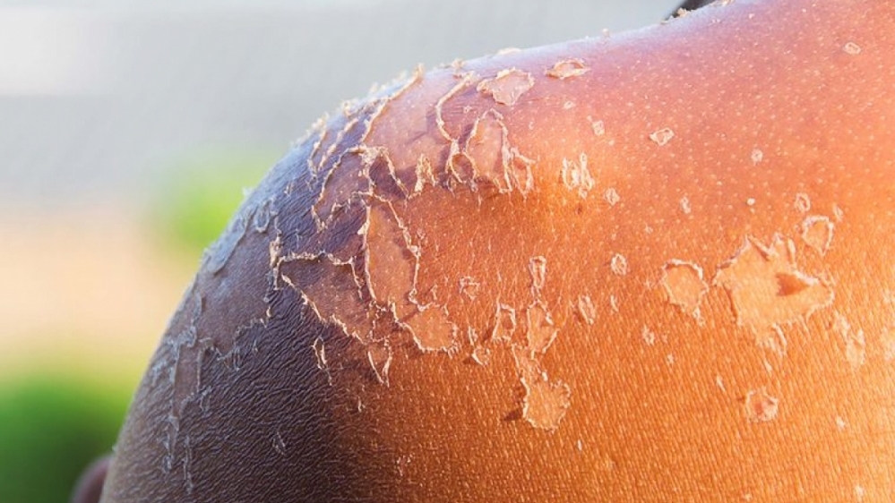 Nếu chẳng may bị cháy nắng, không nên làm 10 điều này