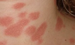 Người vừa được tiêm vaccine Covid-19 có thể gặp những phản ứng da liễu nào?