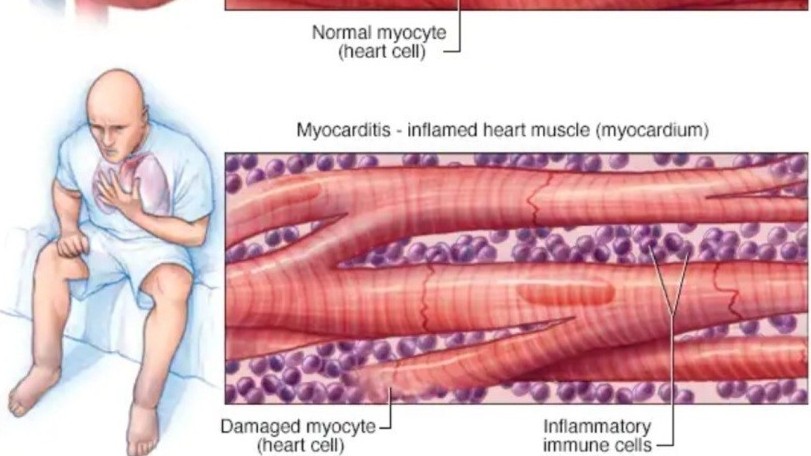 Nhóm người nào dễ mắc viêm cơ tim sau tiêm vaccine Covid-19?