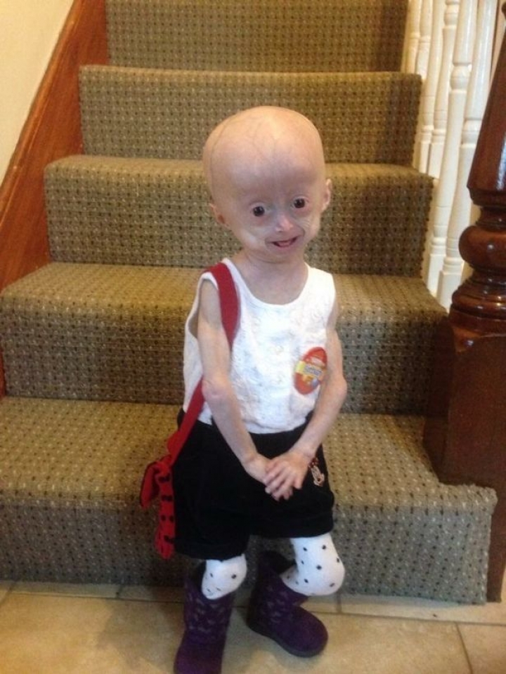 Em bé "người chim" mới 8 tuổi đã qua đời vì... quá già em be nguoi chim moi 8 tuoi da qua doi vi qua gia