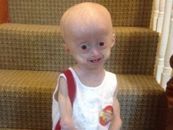 Em bé "người chim" mới 8 tuổi đã qua đời vì... quá già