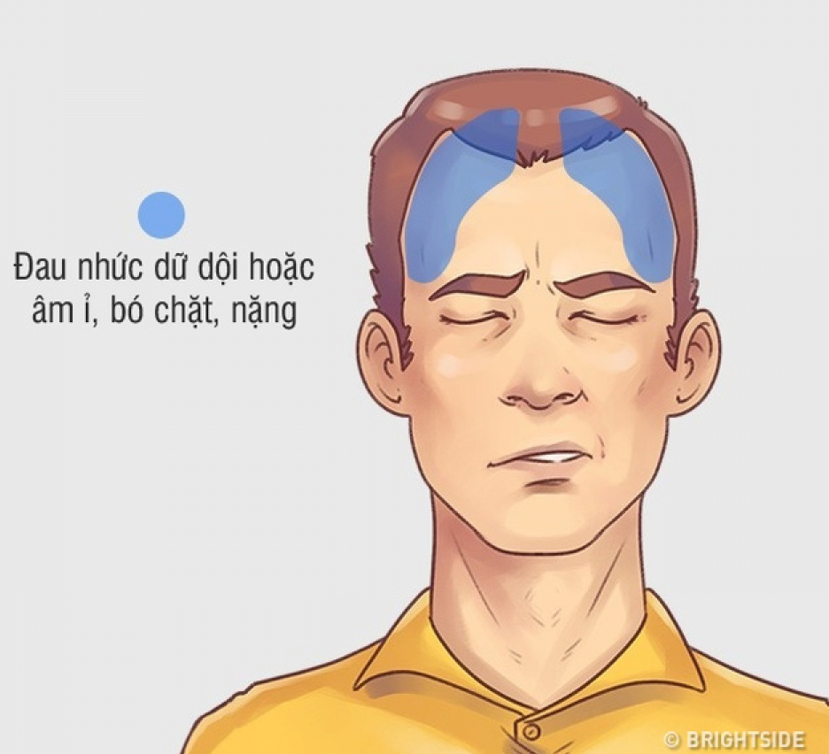 Bí quyết hiệu quả trị 5 kiểu đau đầu hay gặp