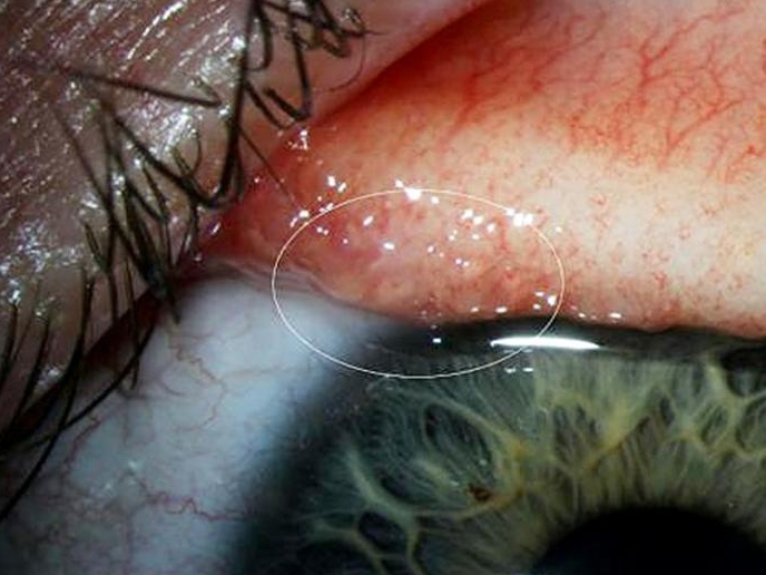 Thấy cộm mắt, phát hiện 14 con giun đang sống ký sinh