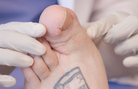 Tháo ngón chân bên cạnh vì ngón chân cái phát triển quá mức