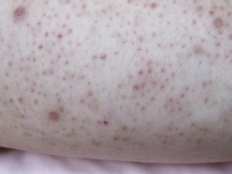 Nguyên nhân của những nổt sẩn đỏ trên cánh tay
