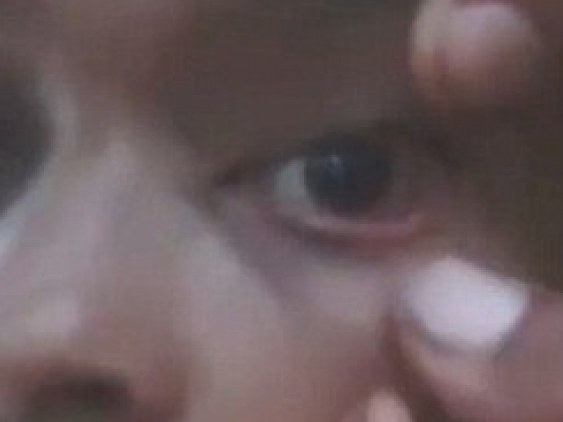 Ấn Độ: Bác sĩ sốc vì thấy cả ổ kiến trong mắt bé gái