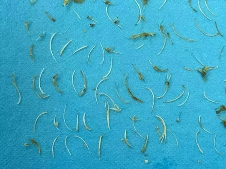 Người đàn ông bị tới 100 mảnh xương cá mắc kẹt trong ruột